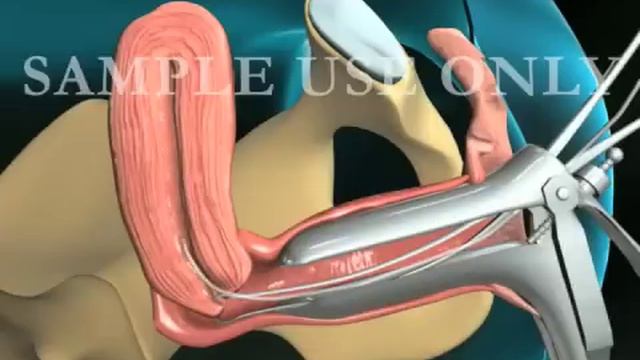 Endometrial Biopsy смотреть онлайн