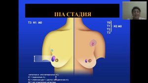 Рак молочной железы