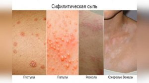 СИФИЛИС: Первичный.Вторичный.Третичный. Врожденный ранний. Врожденный поздний. Симптомы, признаки