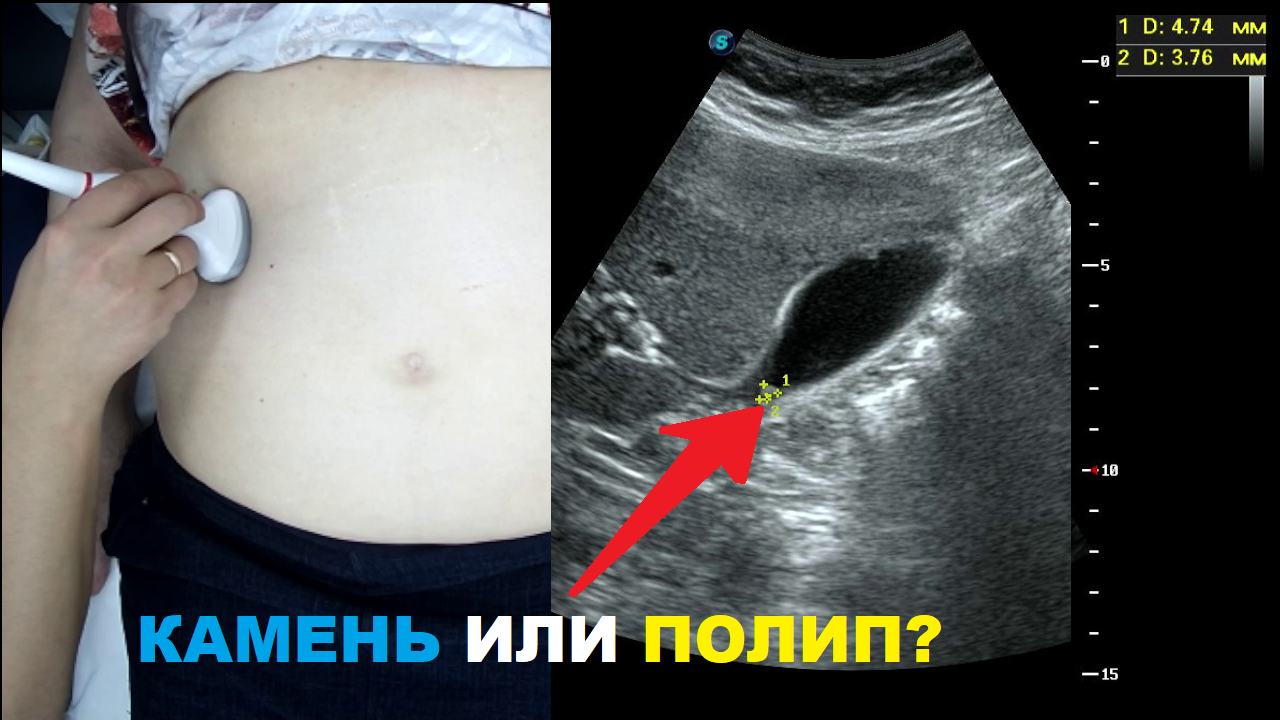Как отличить ПОЛИП желчного пузыря от КАМНЯ желчного пузыря?
