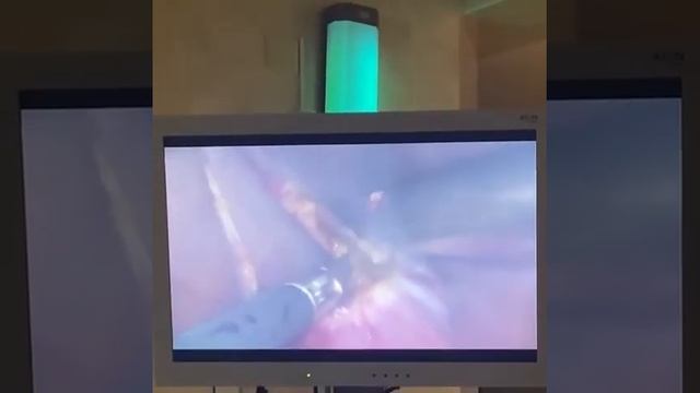 Лапароскопическое удаление кисты почки смотреть онлайн