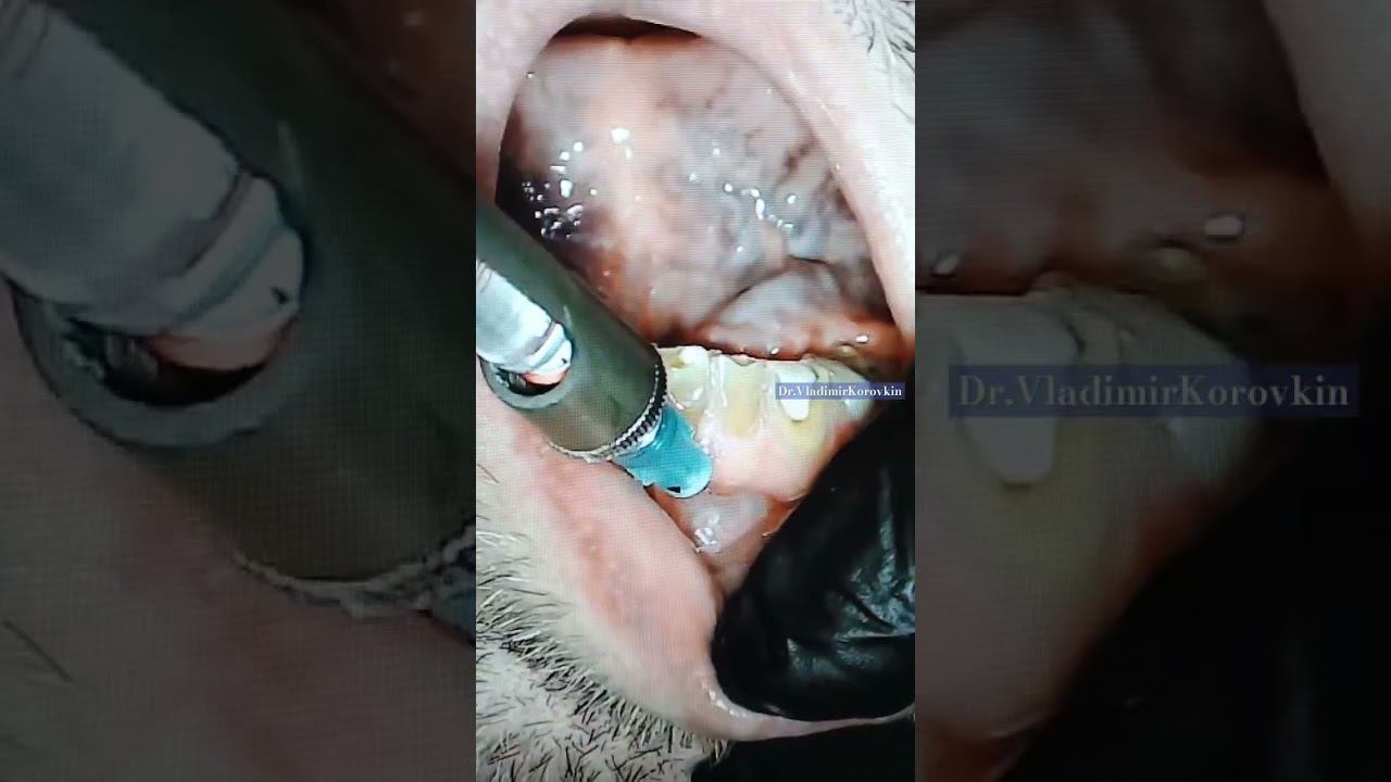 #infiltration #anaesthesia for treatment 31-33th teeth.#localanesthesia