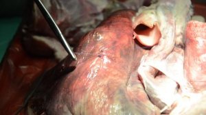 Ушивание раны легкого методом Гарре-Талька