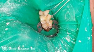 Фиксация контурной матрицы на дистальной поверхности моляра якорным клампом DET.expert & TorVM 4K