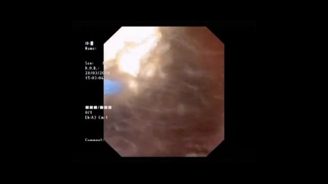 Работа лазера Fiberlase U2. Камень в почке смотреть онлайн