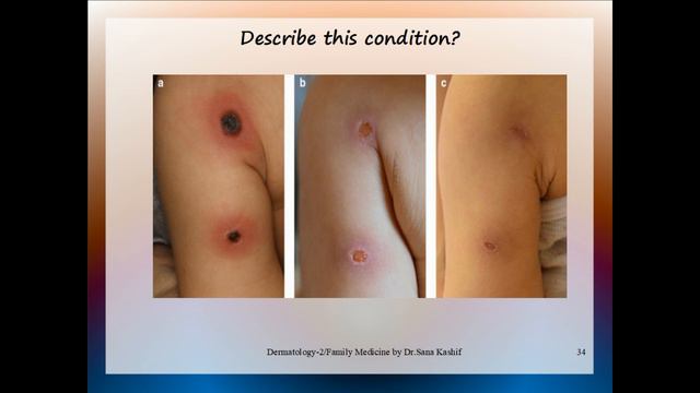 Dermatology-2 PROMETRIC Mrcgp Mcps Family Medicine