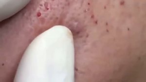 BESTПРЫЩ / КОВЫРЯЕТ ЗАСОХШИЕ ЧЕРНЫЕ ТОЧКИ