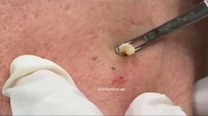 Dr Pimple Popper’s Top 10 Tiktok Pops