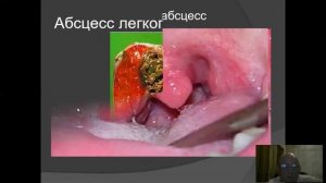 МЕСТНАЯ ГНОЙНАЯ ХИРУРГИЧЕСКАЯ ИНФЕКЦИЯ