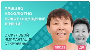 Скуловая имплантация зубов: что делать, если кости для имплантов не хватает