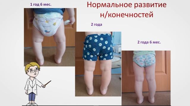 Деформация нижних конечностей