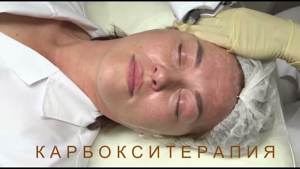 Карбокситерапия
