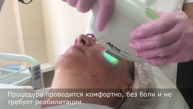 Фотоомоложение кожи