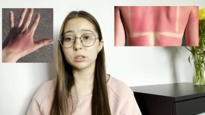 Ожоги, классификации ожогов, определение площади ожога | Патофизиология | Медвуза