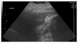 УЗИ на 36 неделе беременности