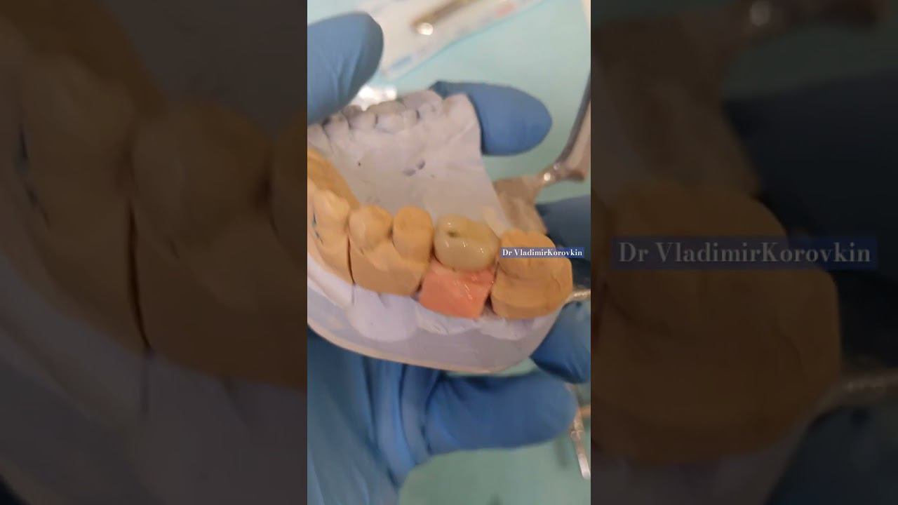 Металлокерамическая коронка винтовая фиксация.46 зуб.#коронканазуб #crowntooth