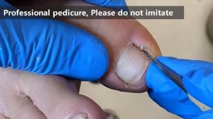 Pedicure tutorial :Lots of dirt and dander under toenails【Xue Yidao】