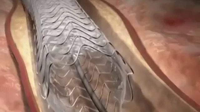 Стентирование коронарных артерий. смотреть онлайн
