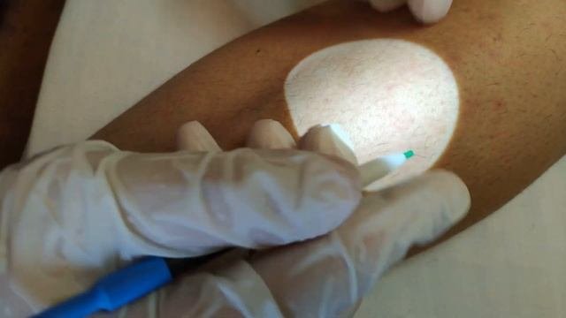 Электроэпиляция на ноге. Variable Depth, Finger Techniques. Electrolysis On Women Leg