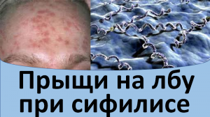 Прыщи на лбу при сифилисе.