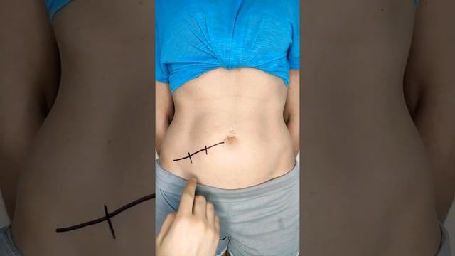 Как БЫСТРО определить АППЕНДИЦИТ? смотреть онлайн