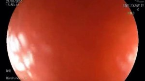 Анастомозит и сужение кишки