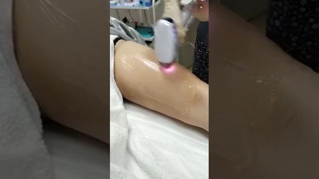 Лазерная эпиляция бедро смотреть онлайн