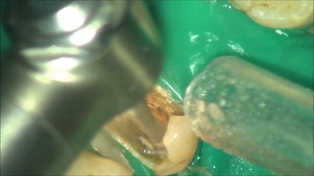 Повторное лечение корневых каналов. Root canal retreatment. смотреть онлайн