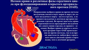 ВПС. Открытый артериальный проток.