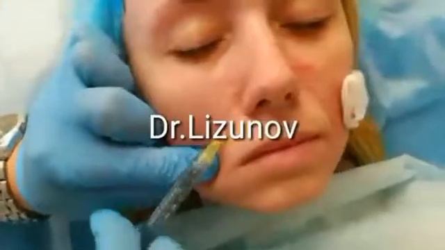Коррекция носогубных складок...