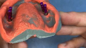 Отливка оттиска с имплантами. İmplant dental impression model making.