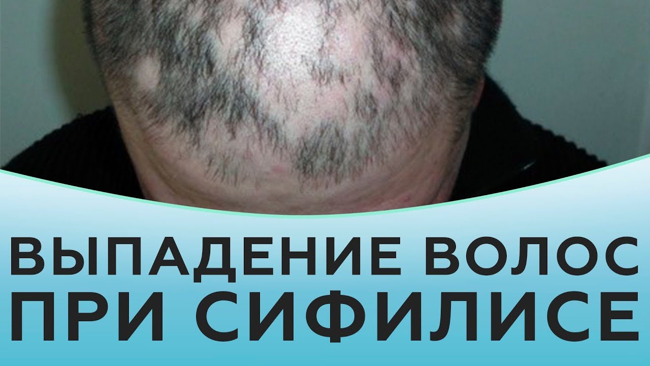 Выпадение волос при сифилисе.