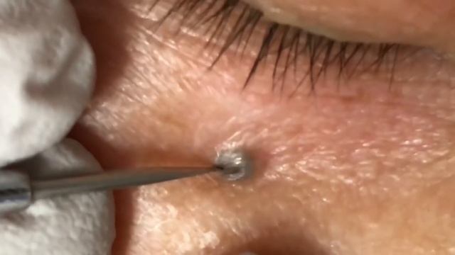 Blackhead