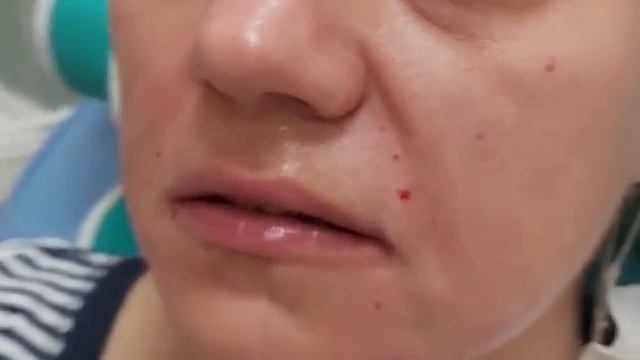 АирисКом студенты учатся: филлер 1 мл. мини коррекция область вокруг рта.