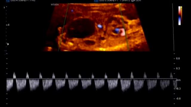 Siêu âm thai 13 tuần: Trisomy 13 смотреть онлайн