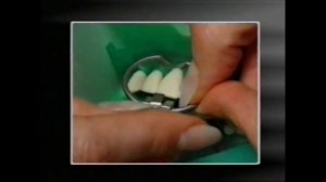 Демонстрация наложения и установки коффердама