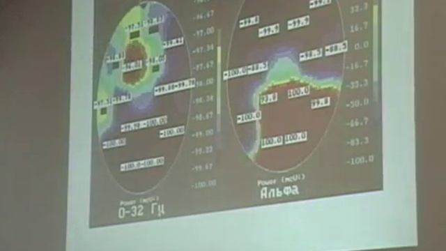 ЭЭГ в процессе лечения эпислепсии смотреть онлайн