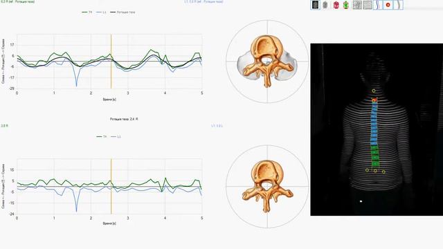 DIERS 4D motion  - диагностика осанки у ребенка