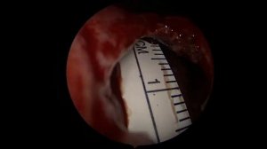 Закрытие перфорации перегородки носа. Nasal perforation repair surgery.