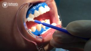 Клиническое отбеливание зубов в Москве