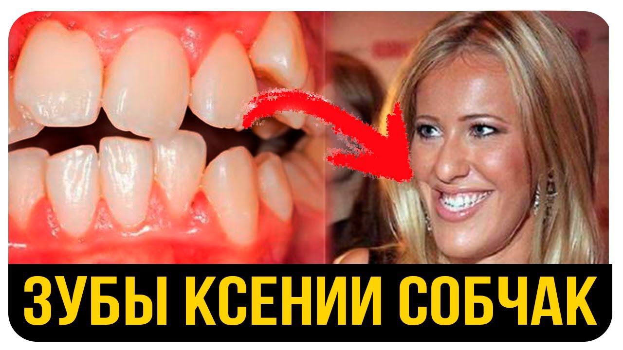 Кривые Зубы Звезд и Знаменитостей. Ксения Собчак. Сколько Стоит Исправление Прикуса?
