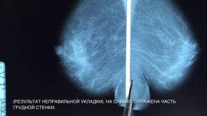 ПРОБЛЕМЫ СОВРЕМЕННОЙ МАММОГРАФИИ!