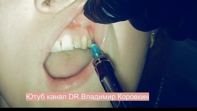 Инфильтрационная анестезия для лечения область 23.