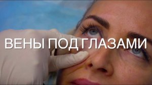 УБИРАЕМ ЛАЗЕРОМ ВЕНЫ ПОД ГЛАЗАМИ / ПЕРИОРБИТАЛЬНЫЕ ВЕНЫ