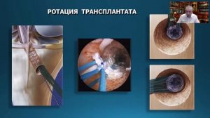 Артроскопия и повреждения передней крестообразной связки коленного сустава. Современные тенденции.