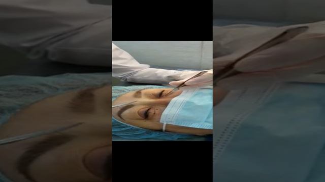Удаление ксантилазмы нижнего века