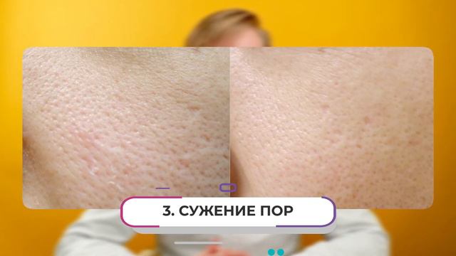 ЭТА процедура избавит от ПРОБЛЕМ С КОЖЕЙ! / Что такое карбоновый лазерный пилинг?