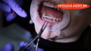 ? Процесс установки сапфировой и металлической брекет системы. Установка брекет системы. 12+.mp4