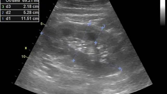 Диффузные изменения паренхимы почек смотреть онлайн