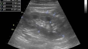 Диффузные изменения паренхимы почек